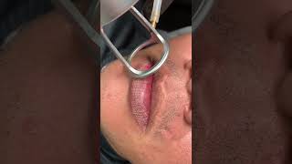 CO2 Laser — Lips