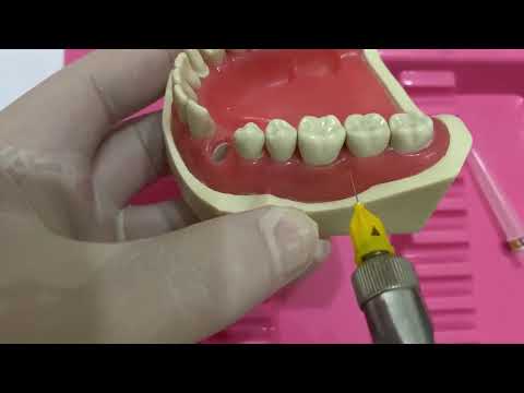 The local anaesthesia in pediatric dentistry: intrapapillary anaesthesia