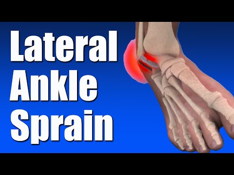 How to Heal a Lateral Ankle Sprain: Essential Rehab Exercises & Techniques
