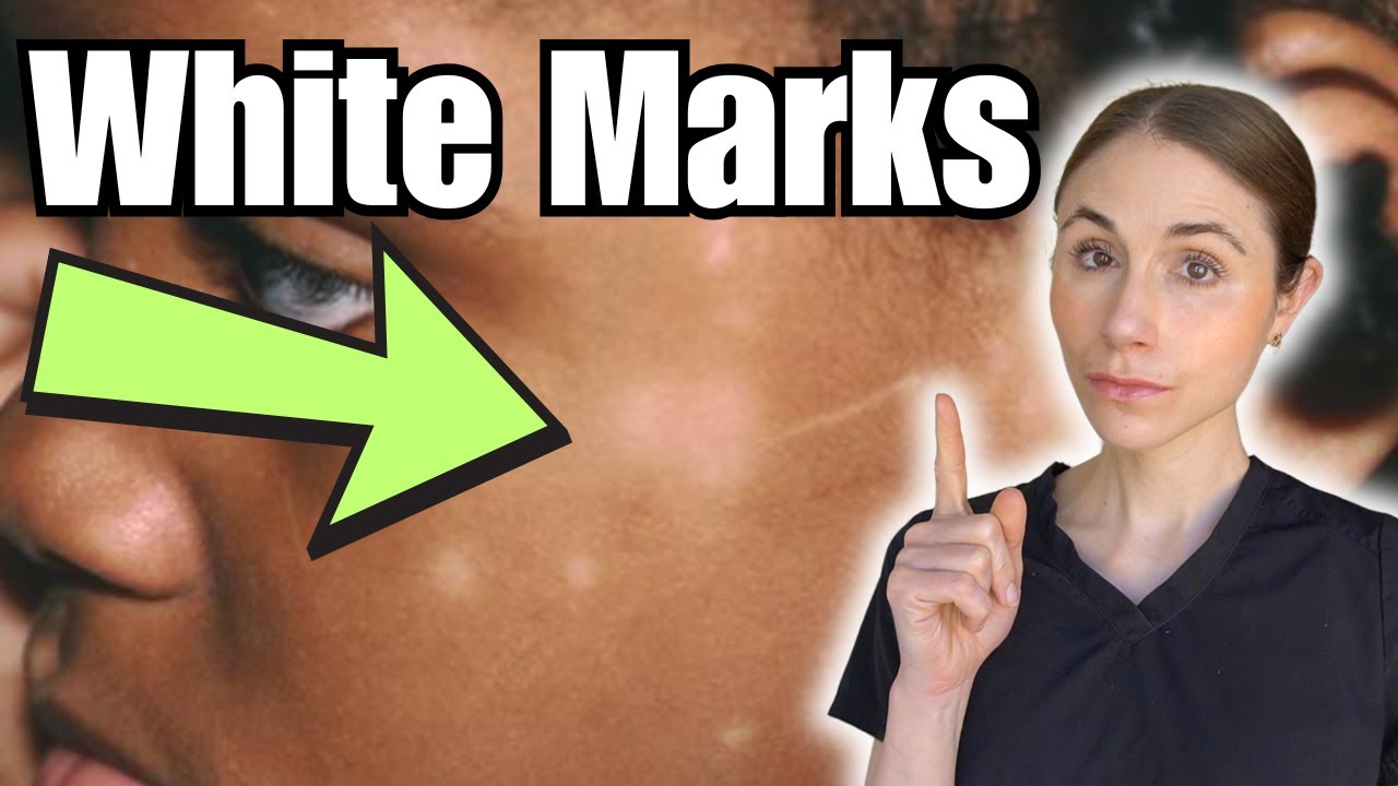 White Marks On The Skin | Hypopigmentation Causes And Treatment