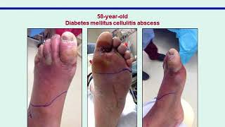 Stimulating Granulation Tissue in Wounds with Instillation: A Guide to Wound Bed Preparation