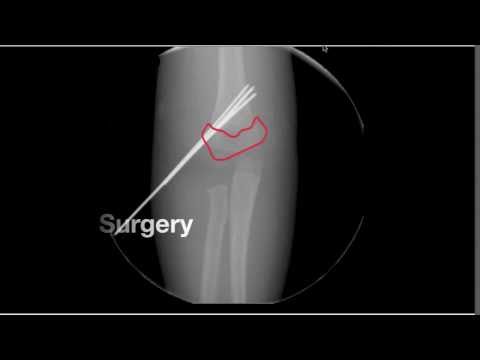 Broken Elbow in Children - Supracondylar Humerus Fracture Treatment
