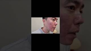 서브시전 성형 시술