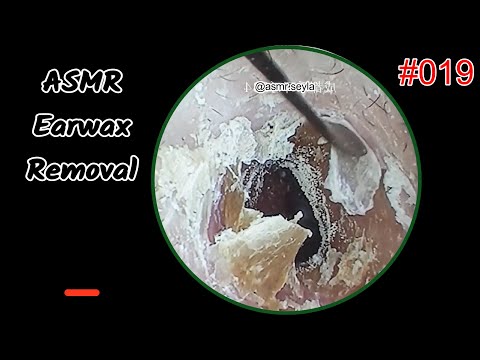 Hard As Nail Golden Earwax | Very Thick To Removal Earwax | Satisfying Ear Wax Removal #019