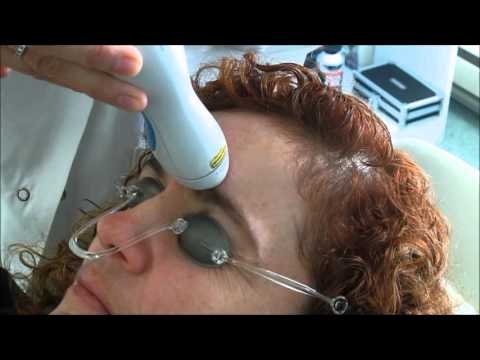 comment traiter melasma