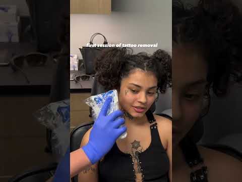 First face tattoo removal session complete!✅
