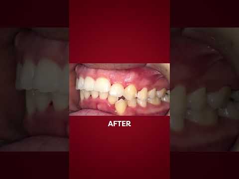 Ratain gigi tonggos tanpa behel?!😱