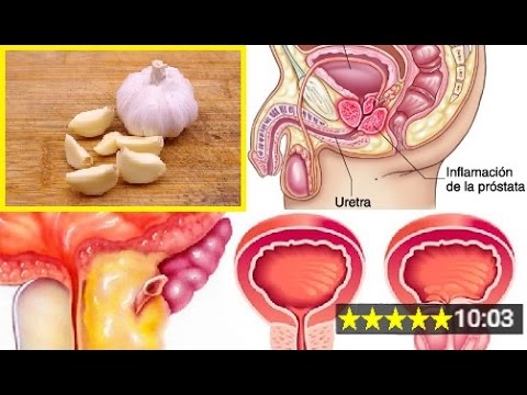 Una biopsia della prostata in Voronezh Restringimento delluretra dopo lintervento chirurgico di BPH