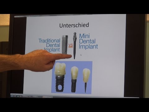 Erfolgreiche Mini-Implantate für den zahnlosen Unterkiefer