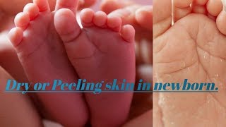 Why newborn having dryness or Peeling in their skin.(IN ENGLISH)