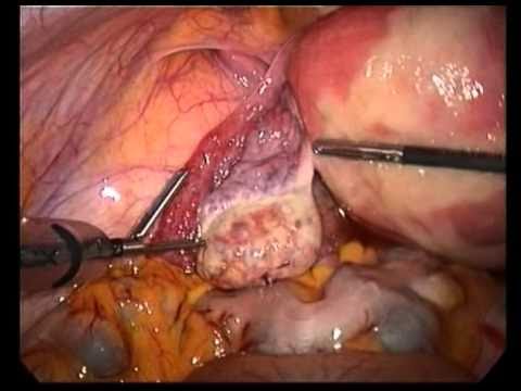 Laproscopic Investigation Of the Ovarian Vein Thrombosis: An  Uncommon Complication