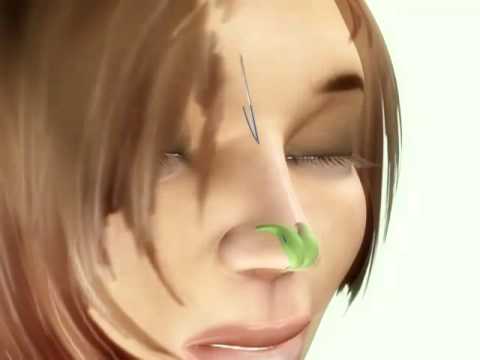 Da quello che appare rughe intorno a occhi Applicazione di sanguisughe in faccia cosmetology