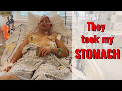 The unseen enemy: Partial gastrectomy, the battle continues