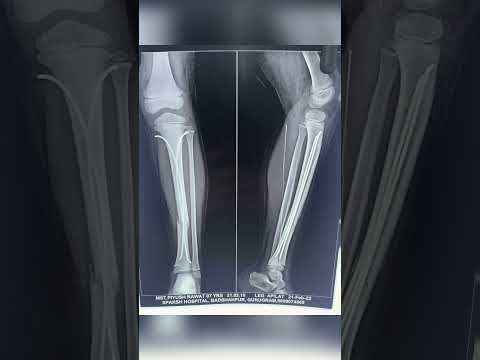 Displaced fracture tibia in kid fixed by TENS system without any cut over fracture site.