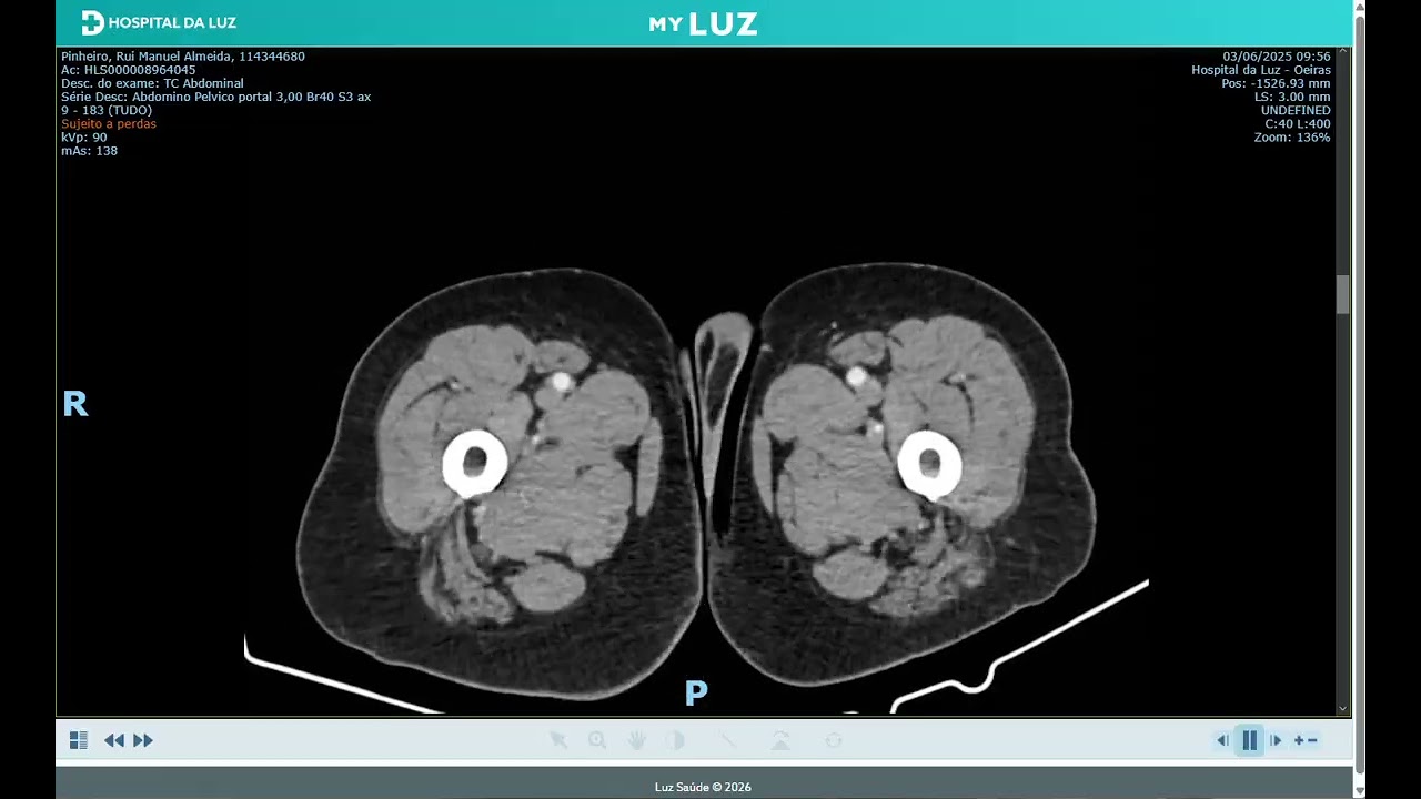 Abdominal CT Thumbnail