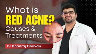 What Is Red Acne Marks? | Causes & Treatments | In Hindi | Dr Dhanraj Chavan | Clear Skin Pune