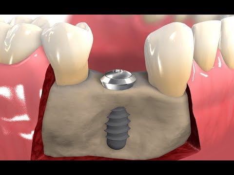 ฟูหน้าอกหลังจาก PLASTY ซื้อชุดชั้นในสำหรับหน้าอกเล็ก