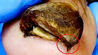 The Patient Has Never Had A Pedicure And The Nails Are Too Heavy【Xue Yidao】