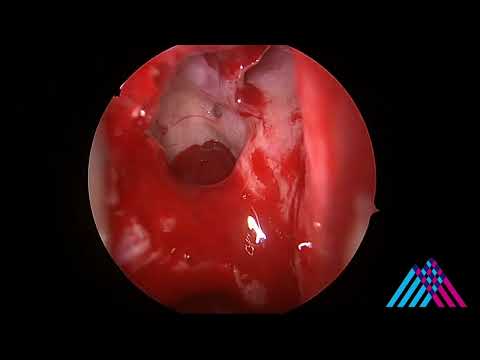 Functional Endoscopic Sinus Surgery (FESS) for sinusitis