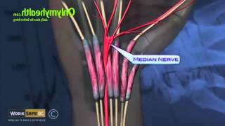 What is Carpal Tunnel Syndrome