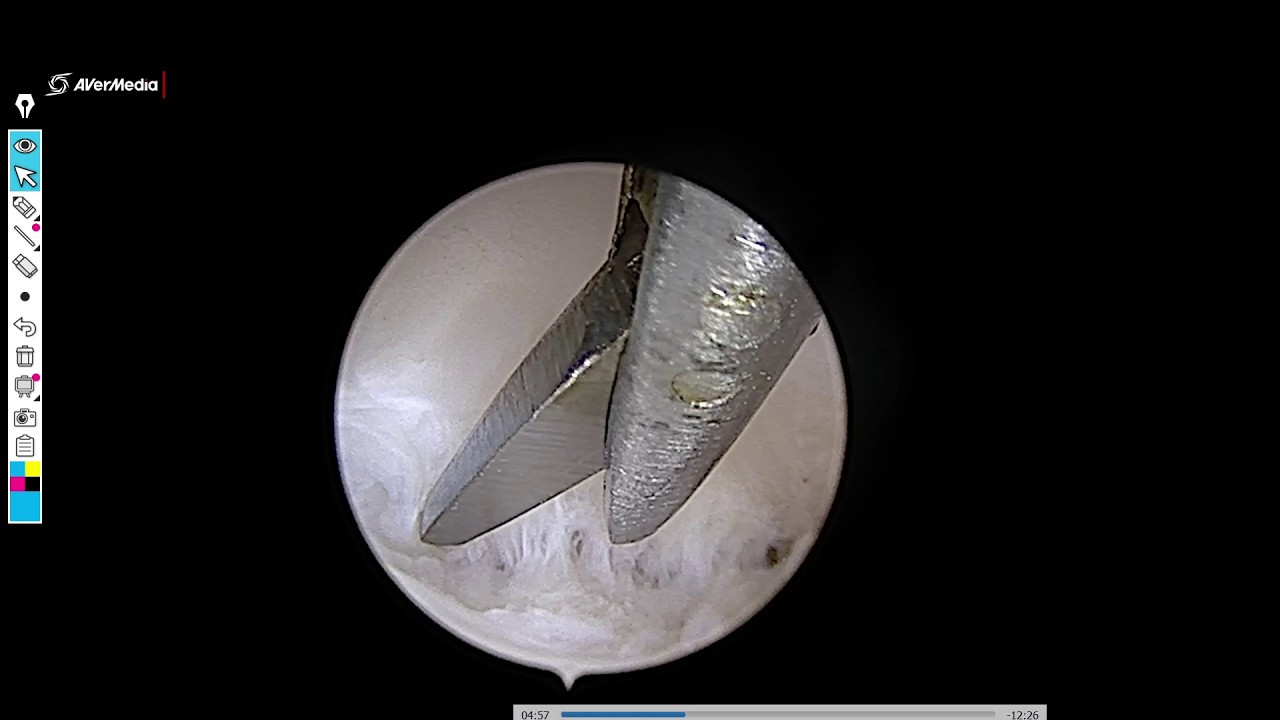 Hysteroscopy - Ashermann's Syndrome with PRP injection | Dr Sanket Pisat - YouTube video featuring the word signs
