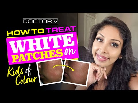 Doctor V -  How To Treat White Patches On Kids Of Colour | Skin Of Colour | Brown Or Black Skin