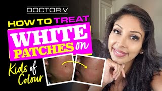 Doctor V -  How To Treat White Patches On Kids Of Colour | Skin Of Colour | Brown Or Black Skin