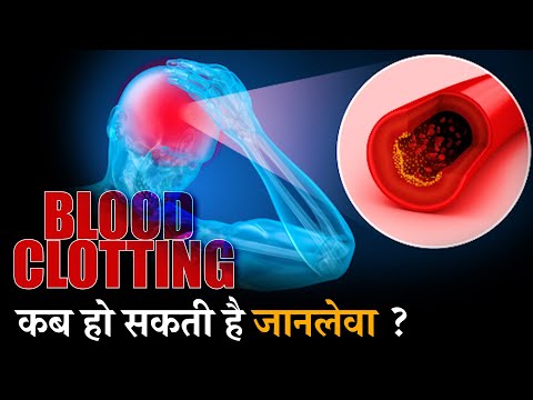 Blood clots:The good, the bad and the deadly.