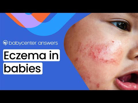 Baby eczema: Symptoms, triggers, and treatments