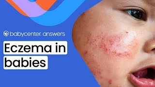 Baby eczema: Symptoms, triggers, and treatments