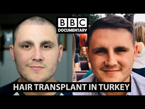 Hair Transplant Turkey - BBC Documentary | Paul Before...