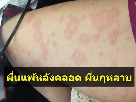 เจลาตินที่เป็นโรคสะเก็ดเงิน ความคิดเห็นโรคสะเก็ดเงิน Eplan
