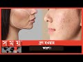 ব্রণ কেন হয়? | Acne | Skin Care | Somoy TV