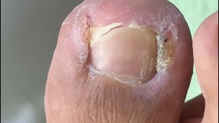 Ep_8694 Ingrown toenail removal 👣 หนังพวกนี้ไม่ลอกออกจะมีผลอะไรครับ 😅 (clip from Thailand)