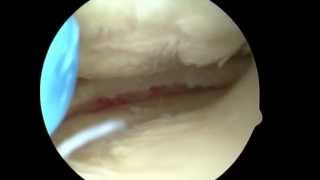 Partial Medial Meniscectomy & Chondroplasty