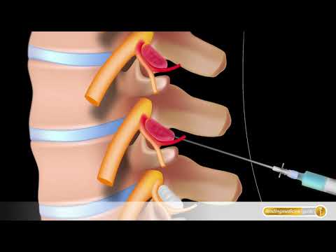 Behandlung von Osteoarthritis Injektionen Namen Was sind die Tabletten von Beingelenken