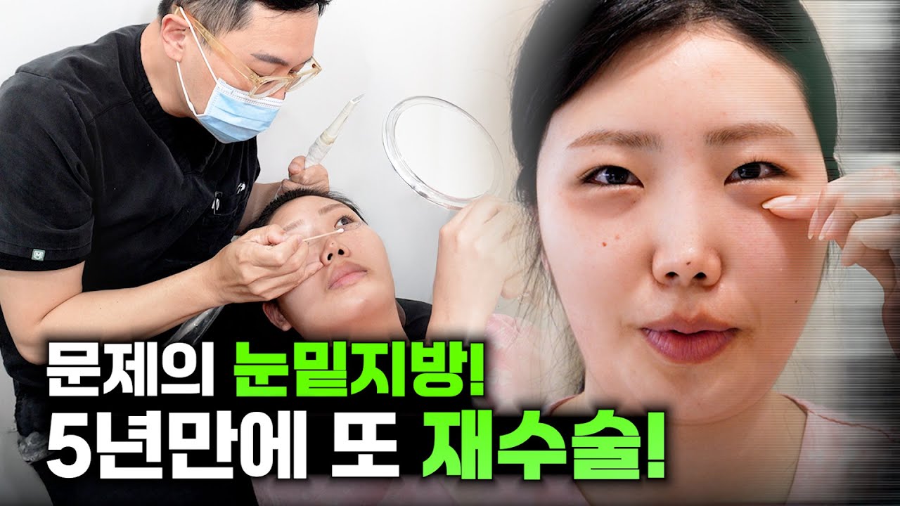 눈밑지 수술, 필러, 리프팅 실패 후 최후의 선택