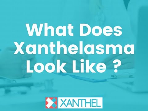 What Does Xanthelasma Look Like