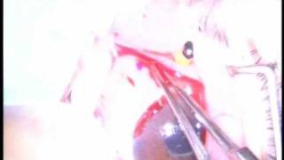 Vitrectomy and Choroidal Drainage