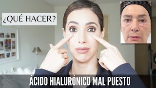 Qué hacer si me pusieron el relleno de ojeras de ácido hialurónico mal y ejemplo de uno bien puesto