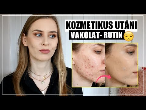 paraziták süllőben test méregtelenítés tünetei