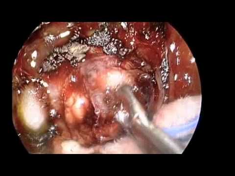 Endoscopic Removal of Pituitary Apoplexy