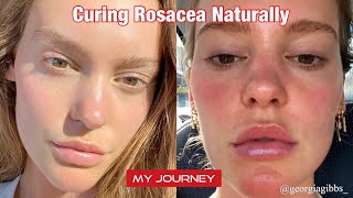 Cure Rosacea Naturally | Georgia Gibbs | My Experience | No filter