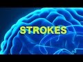 Strokes The Rule Of 4s USMLE