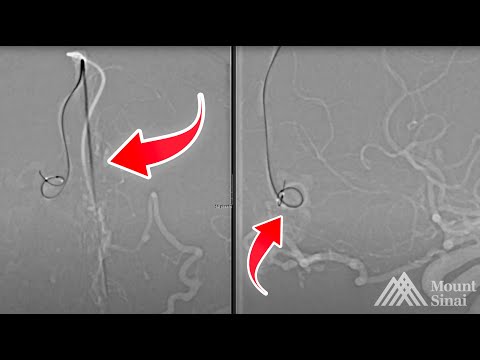 Anterior Ethmoidal Fistula: Transvenous Balloon Assisted Approach