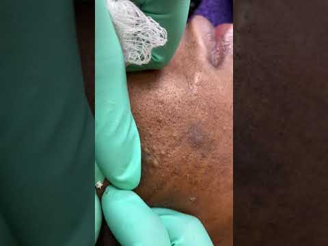 Face Blackhead Removal