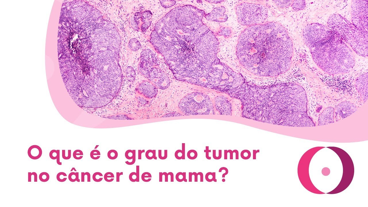O que é o grau do tumor no câncer de mama?