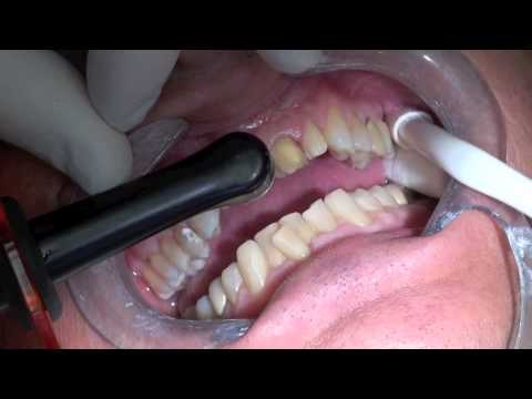 Placing Porcelain Veneers - Tack and Wave Technique