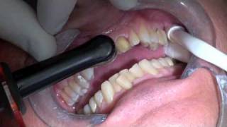 preview picture of video 'Placing Porcelain Veneers by Boca Raton Cosmetic Dentist'