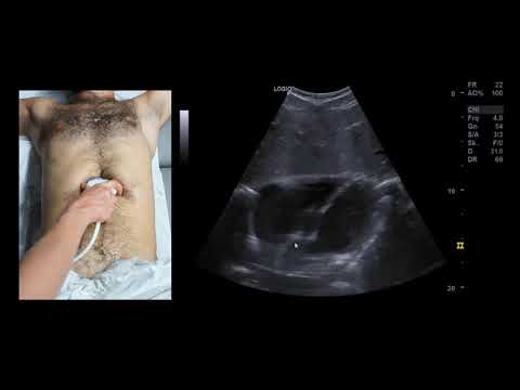 Emergency sonography: eFAST protocol (fast-track)